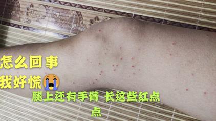 腿上小红点不痛不痒 西瓜视频