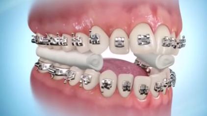 牙齿凹陷矫正 西瓜视频