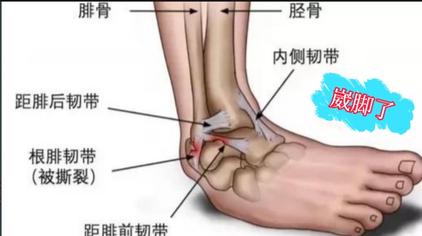 崴脚外侧韧带2 3度拉伤 西瓜视频