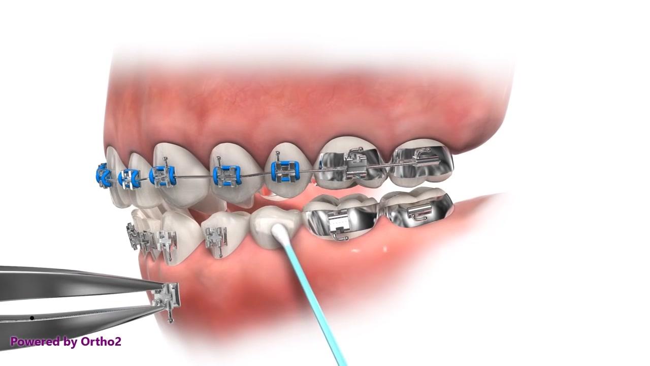 金属托槽矫正操作过程 不能吃硬的东西 西瓜视频
